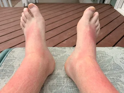 Sunburned after a day outside in Costa Rica